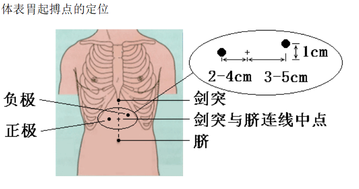 胃腸動(dòng)力治療儀起搏點(diǎn)定位